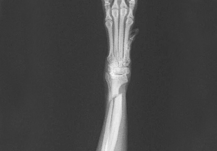 橈尺骨骨折のレントゲン写真