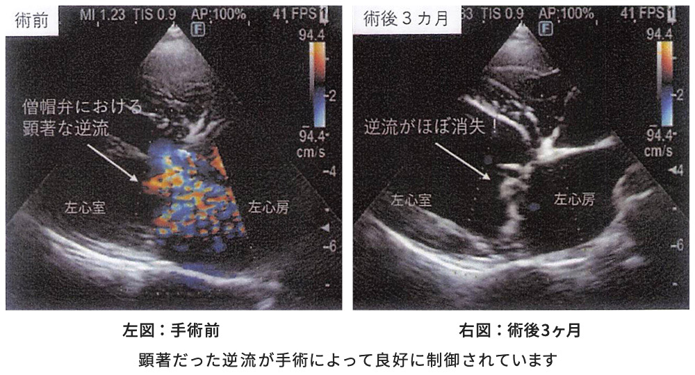 当院での僧帽弁形成術(MVP)実施後の経過エコー写真